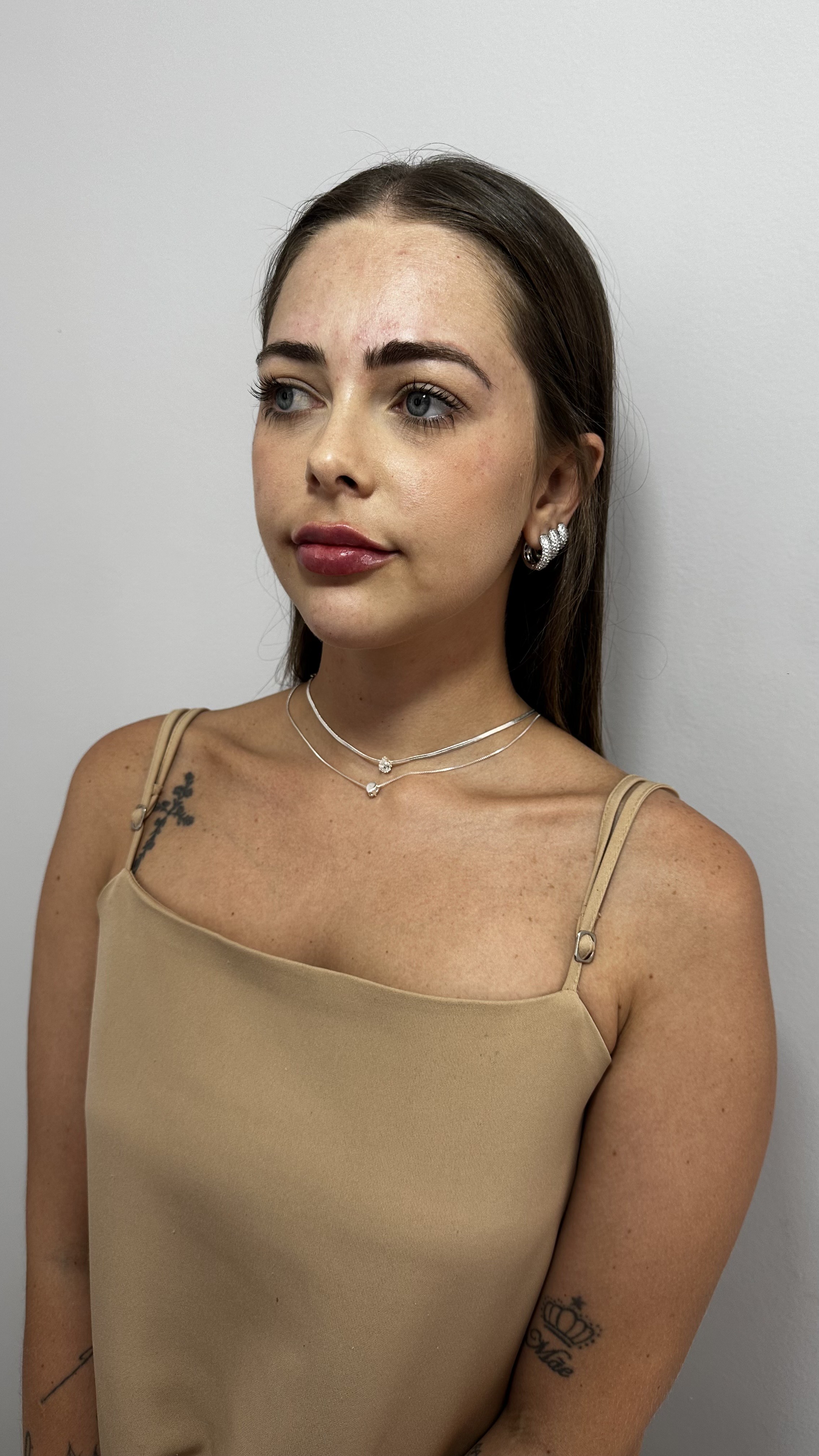 Depois - Perfiloplastia